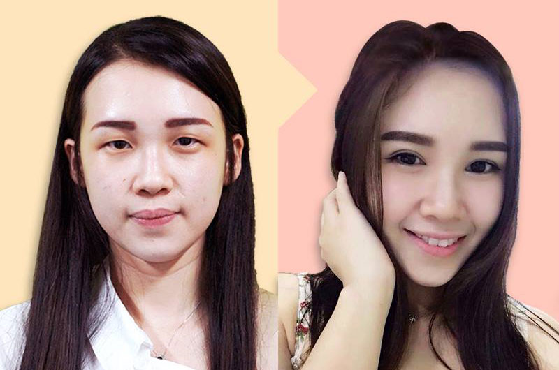 Double eyelid hot sale surgery malaysia