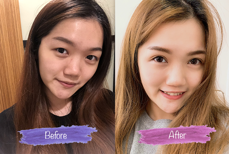 Double Eyelid Surgery in Malaysia - Price & Review | Kalo