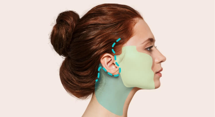 Face Lift Malaysia - Surgery 10 surgical03 smas