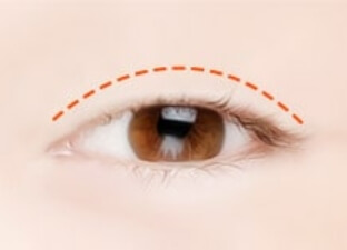 nonsurgical procedure01