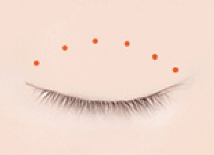 nonsurgical procedure02