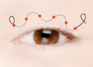 nonsurgical procedure03