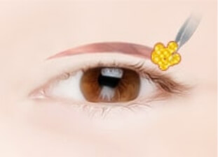 surgical procedure02