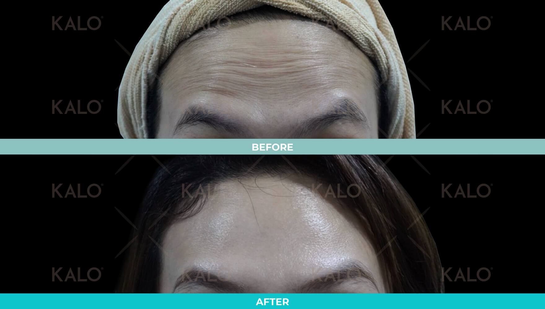 Botox 2