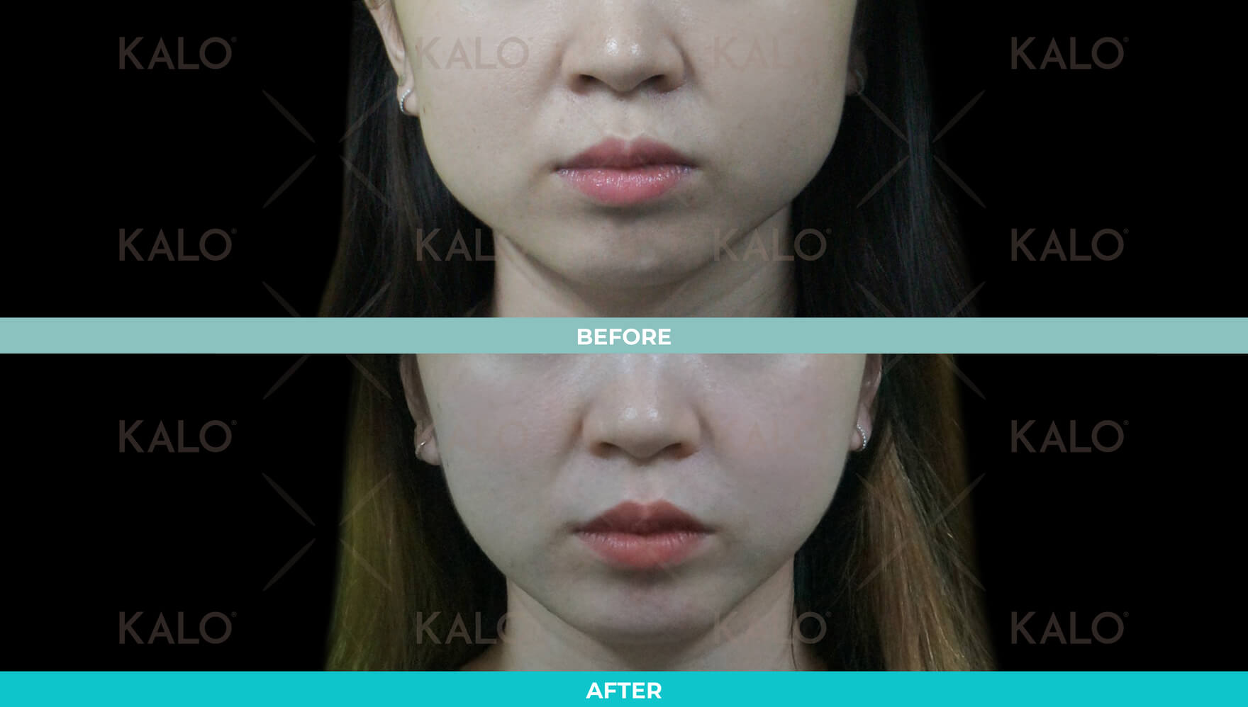 Botox 3
