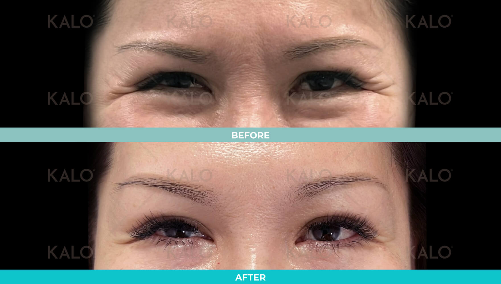 Botox 4
