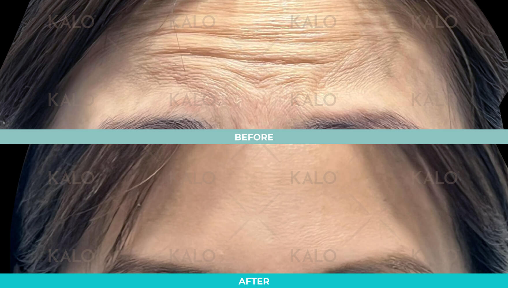 Botox 6