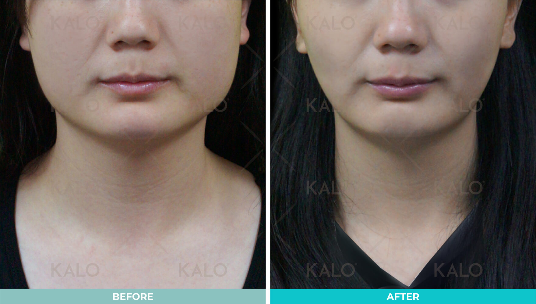 Buccal fat Removal