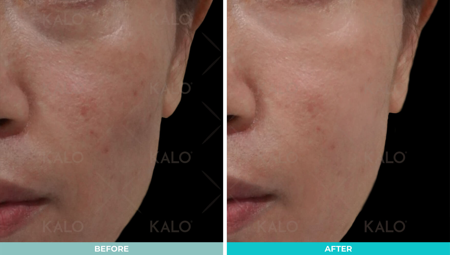 Ultracol | Collagen Biostimulator 1 Collagen Stimulator 1