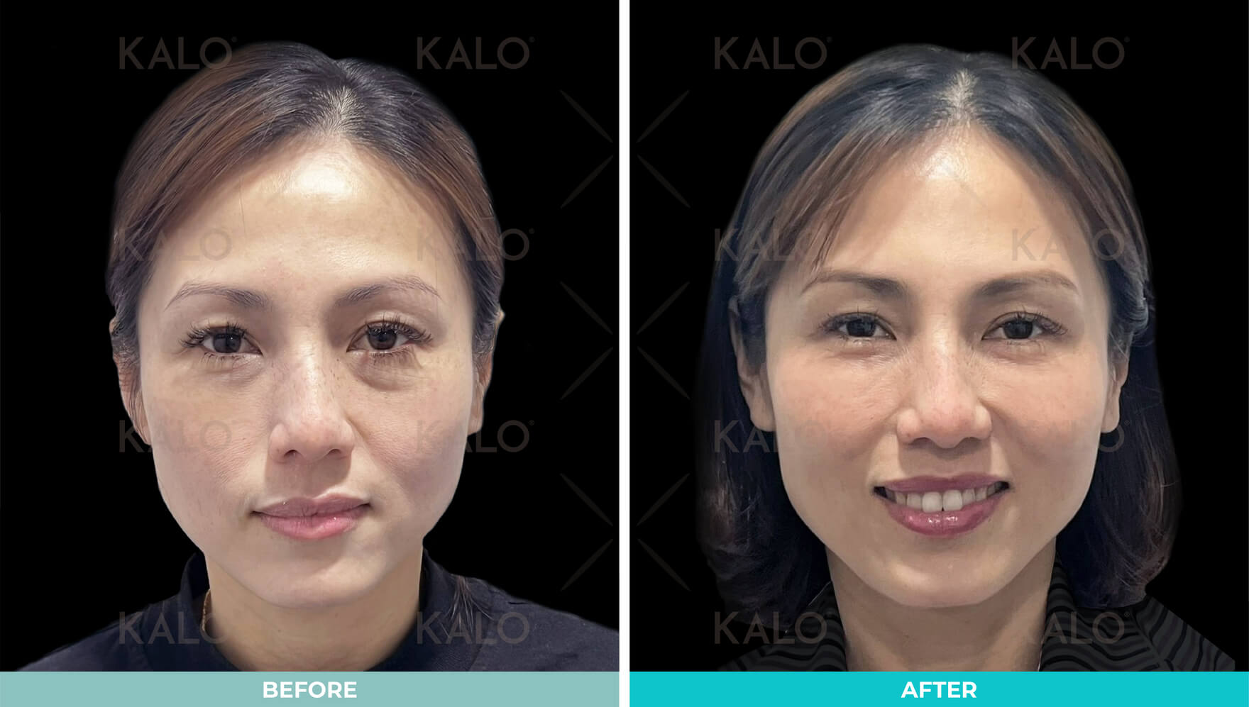 Ultracol | Collagen Biostimulator 2 Collagen Stimulator 2