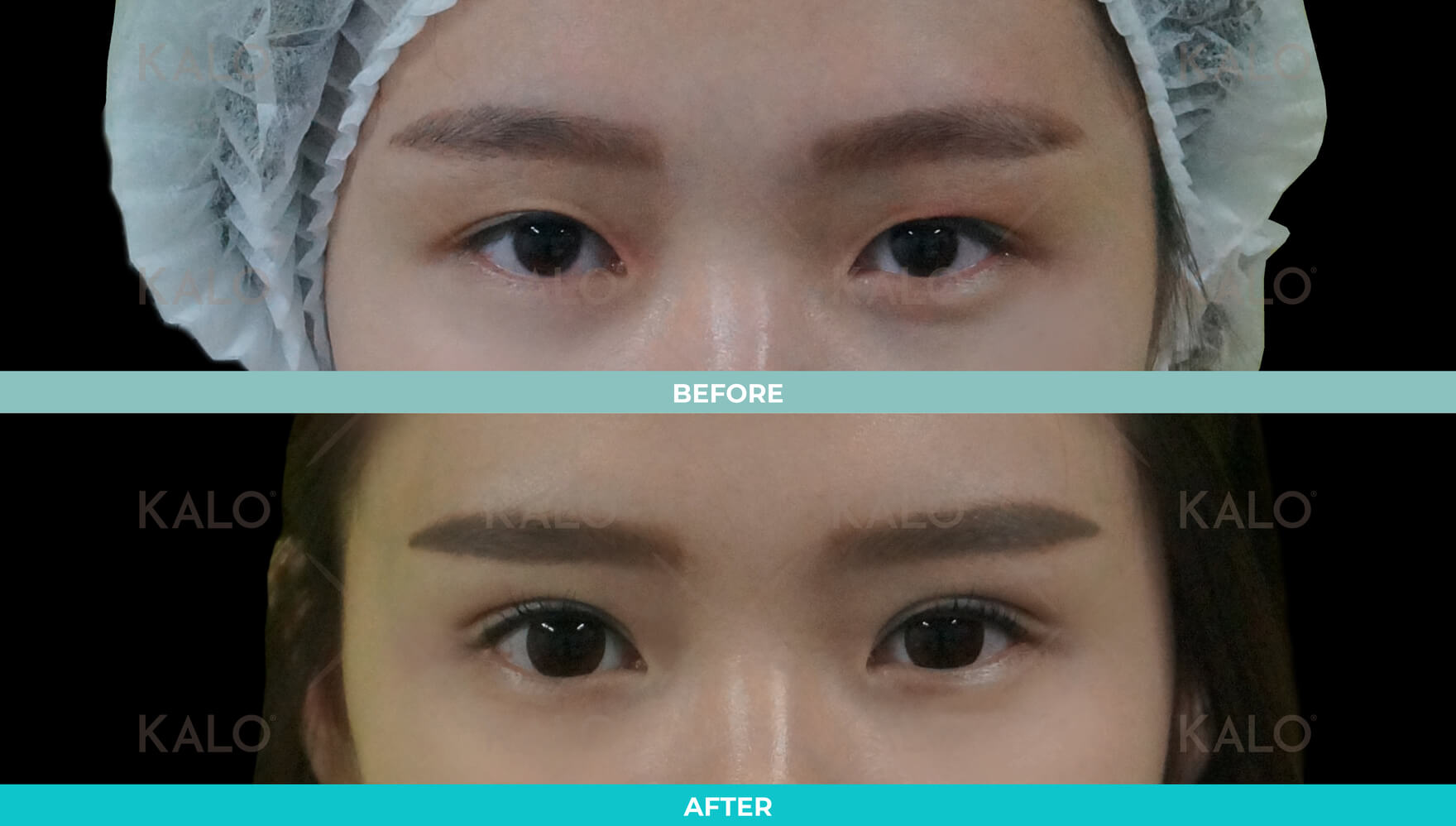 Double Eyelid 1