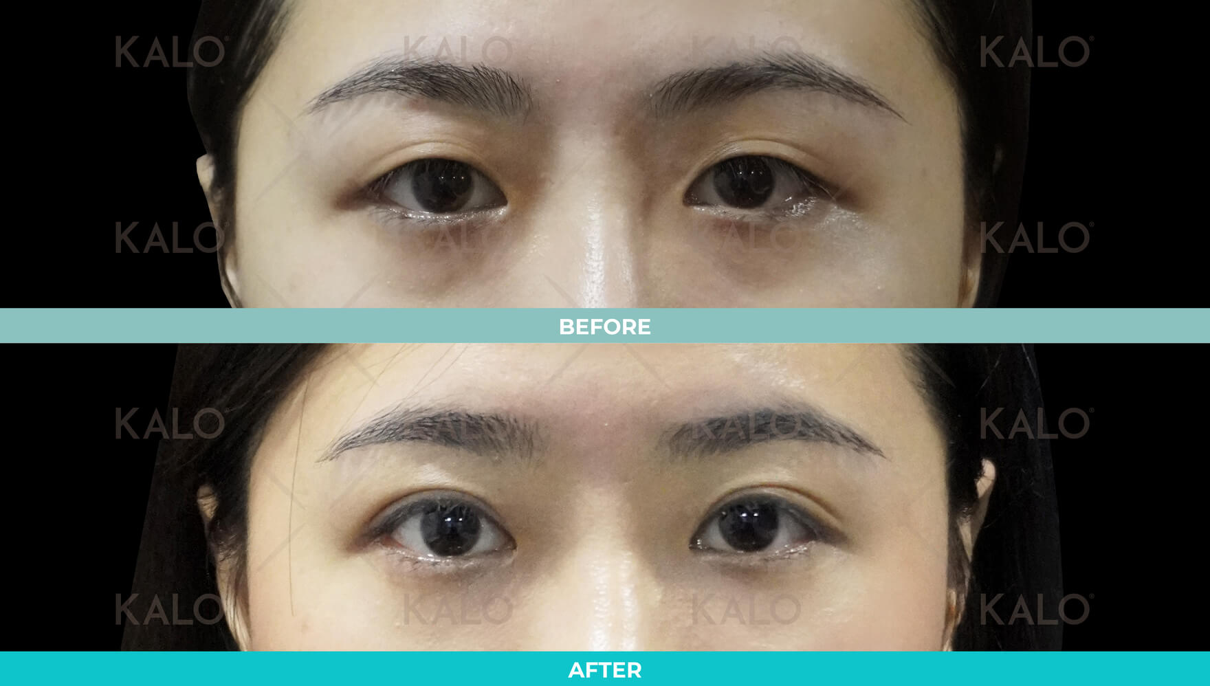 Double Eyelid 2