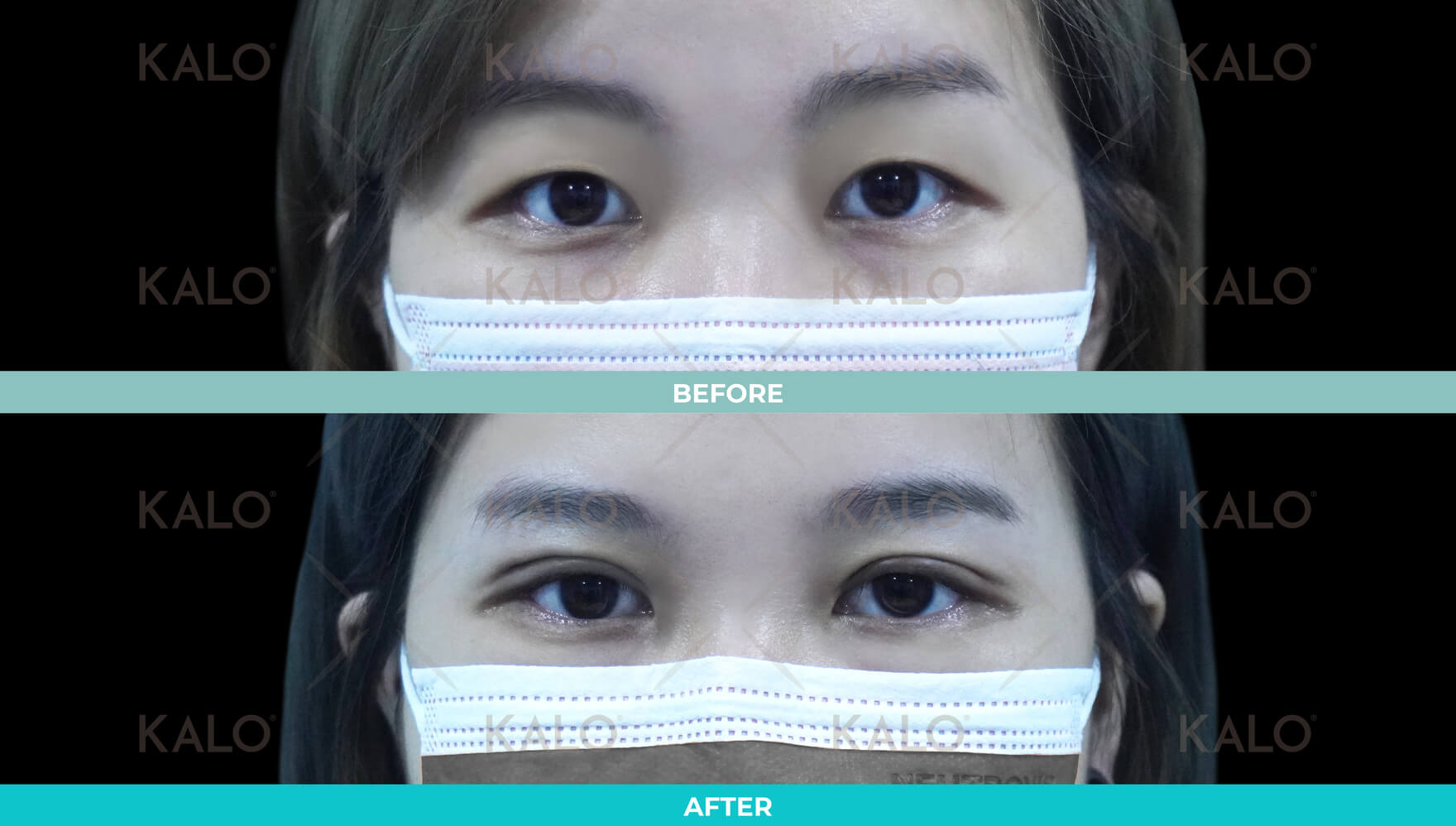 Double Eyelid 4