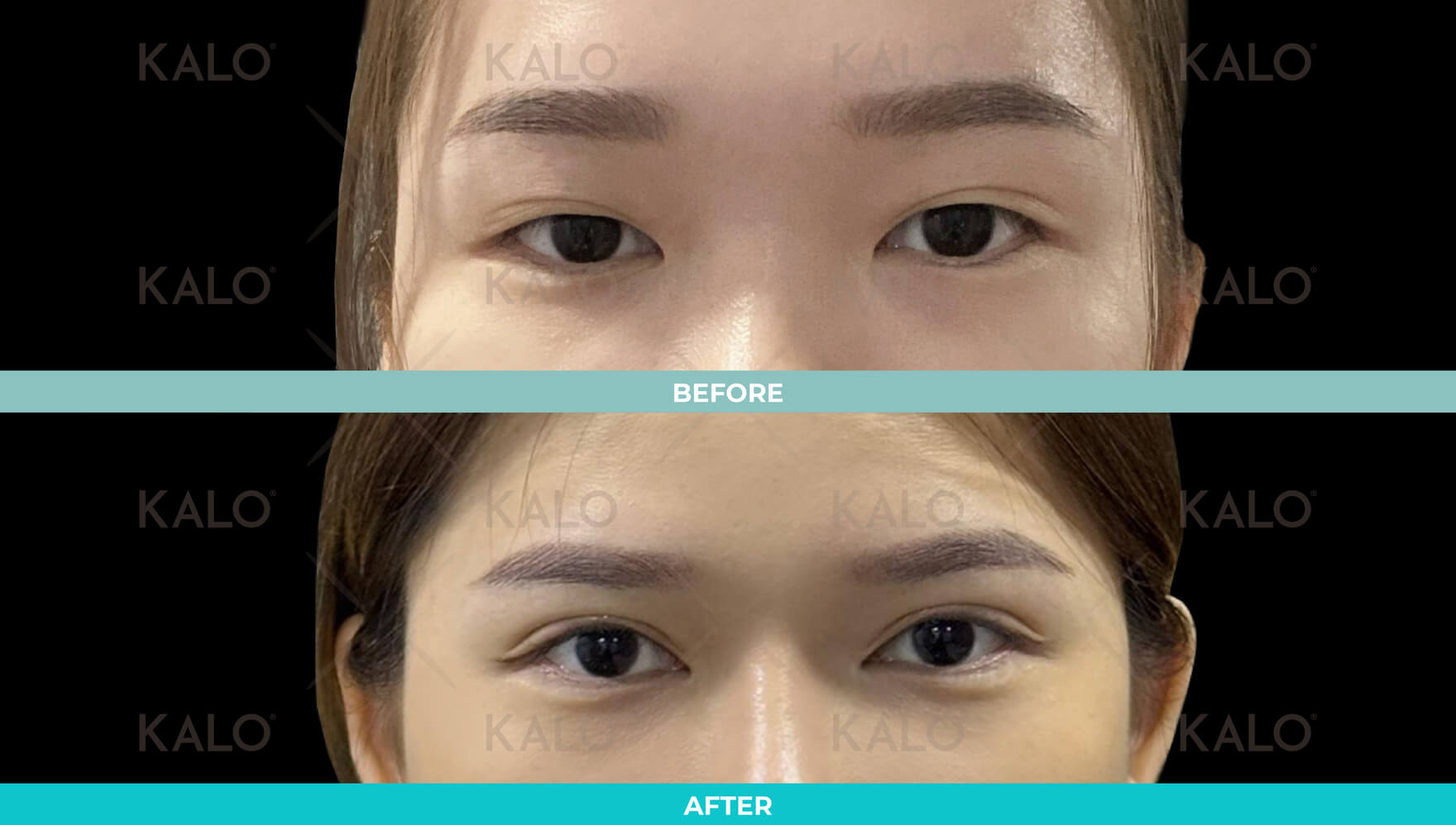 Double Eyelid 5