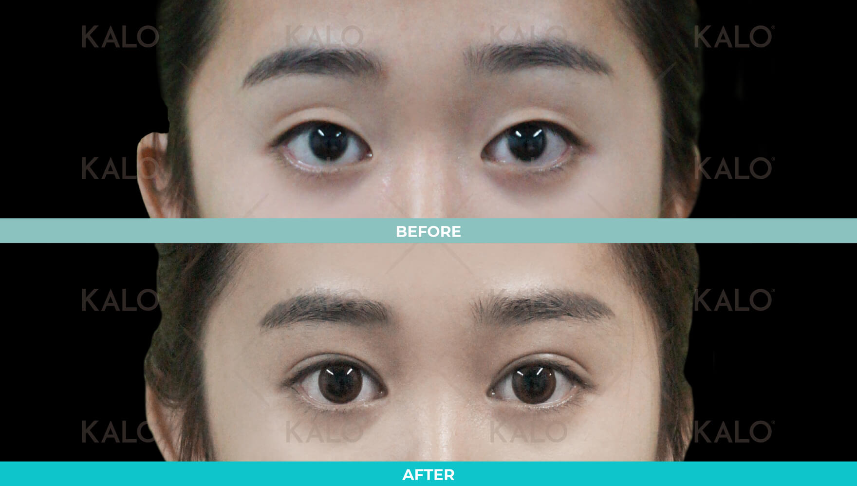 Double Eyelid 6