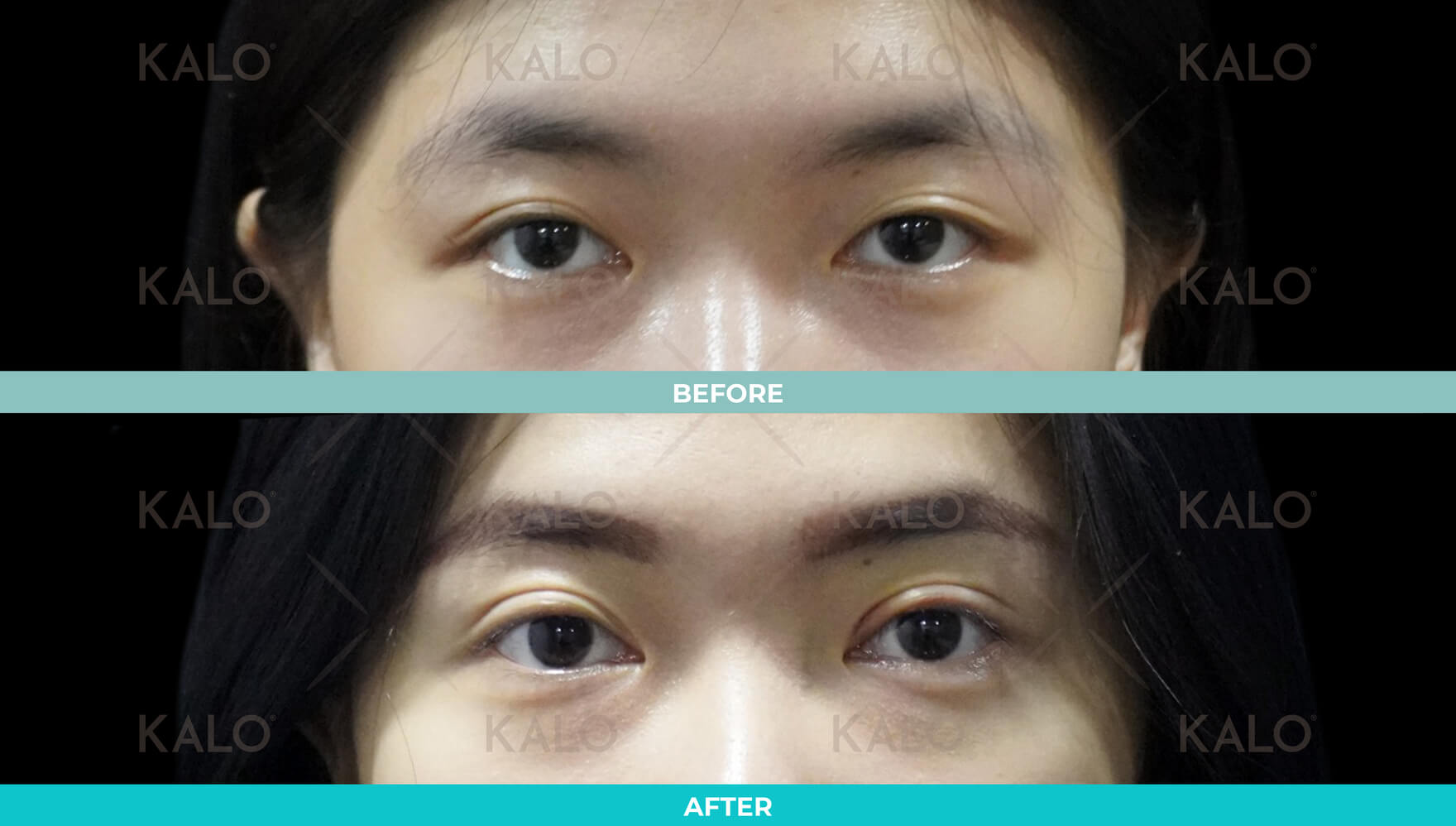 Double Eyelid 8