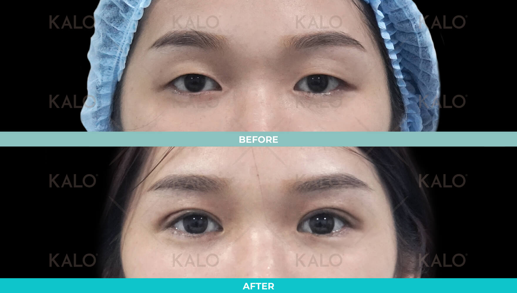 Double Eyelid 9
