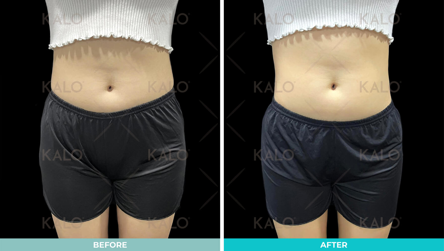 Emsculpt 1 02