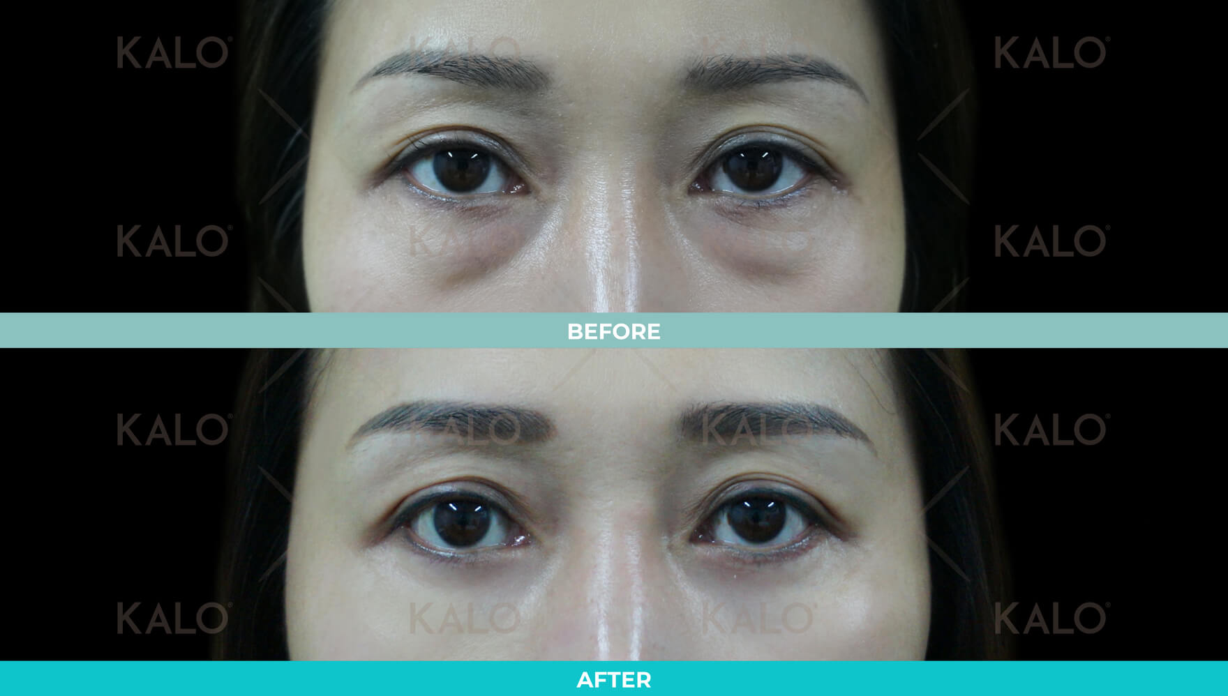 Eyebag 5 01
