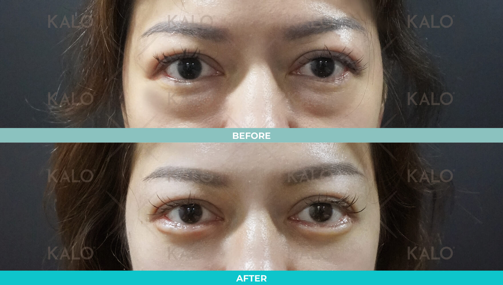 Eyebag Removal 1