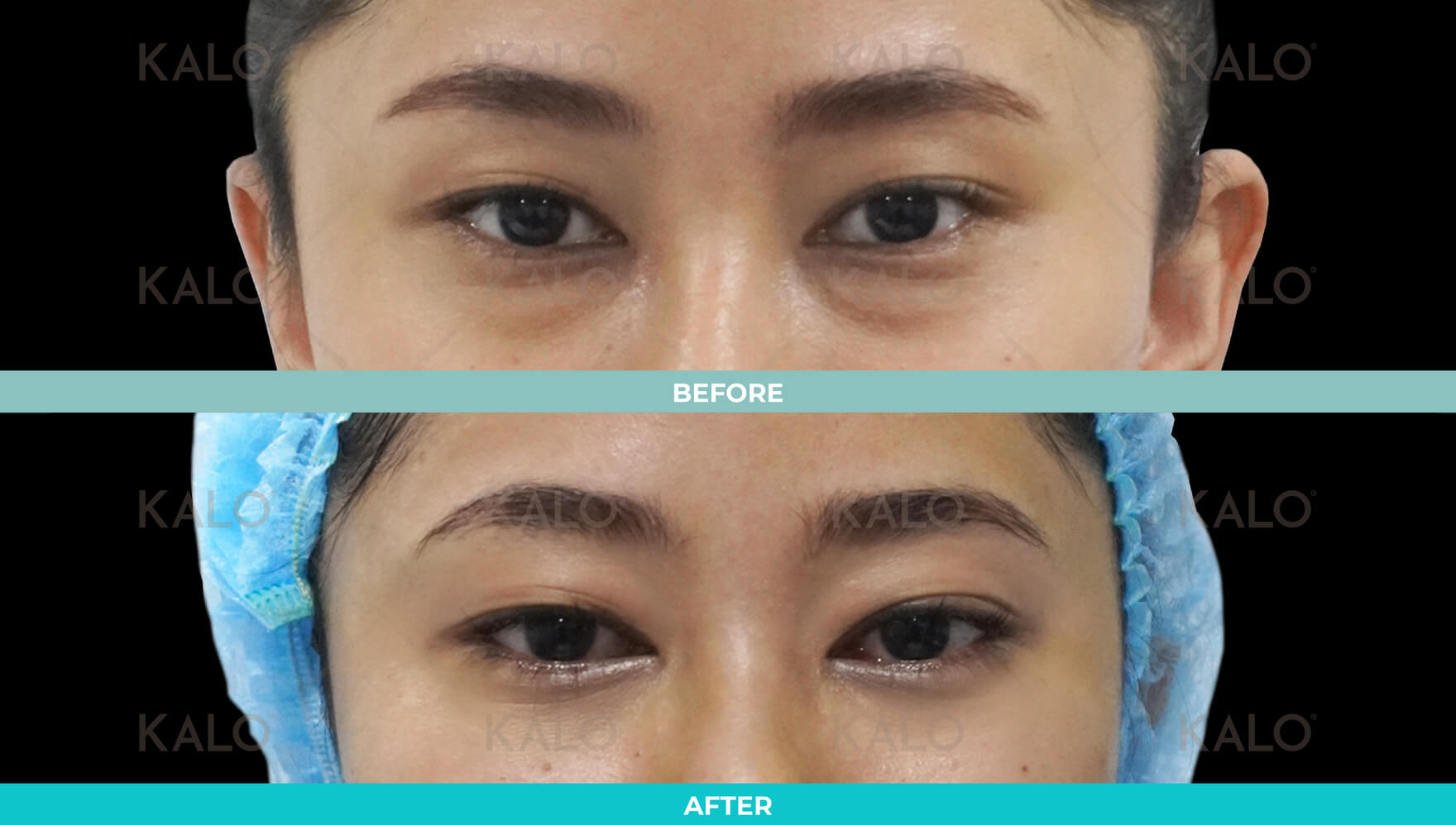 Eyebag Removal 2 01