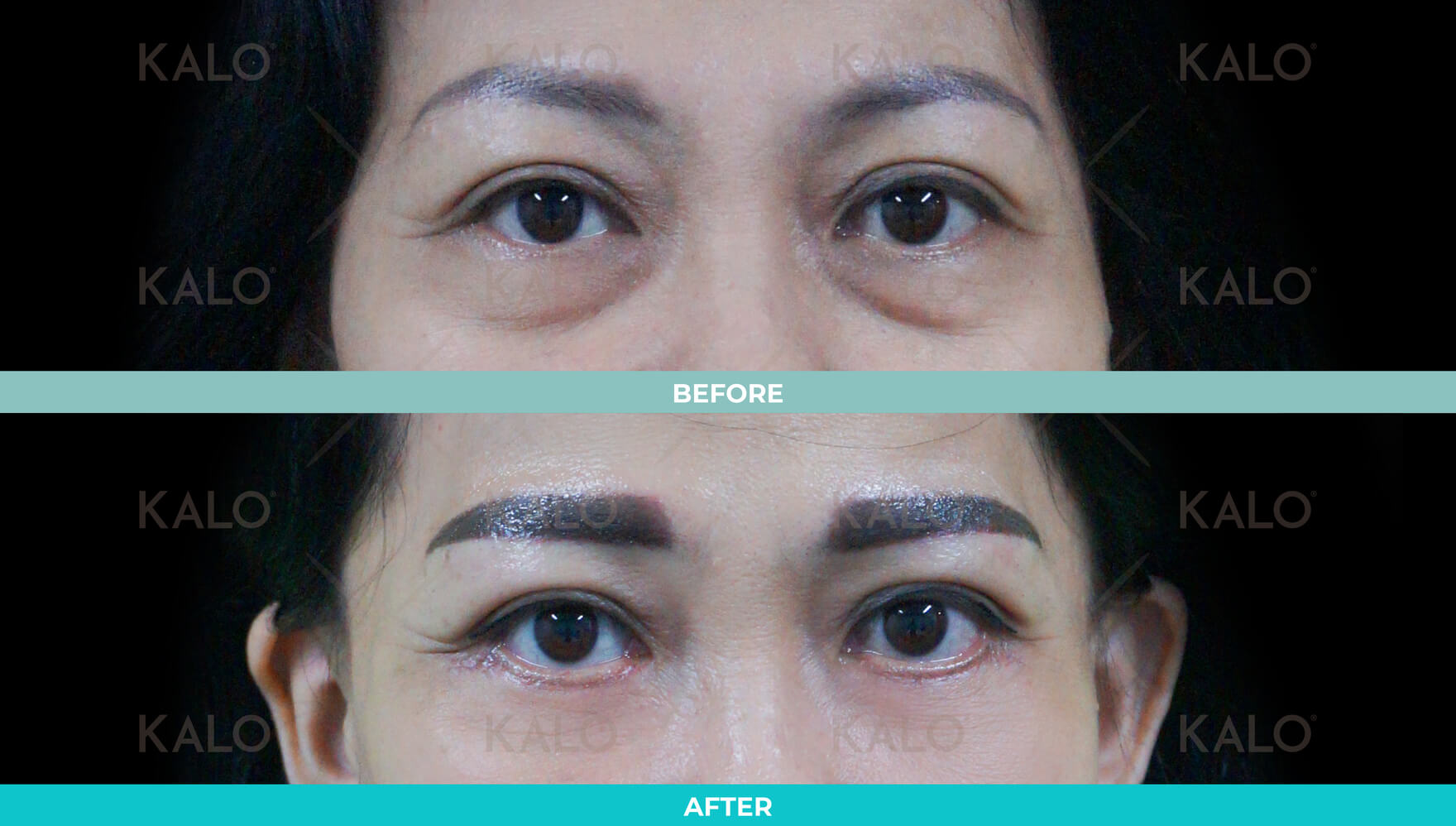 Eyebag Removal 4 01