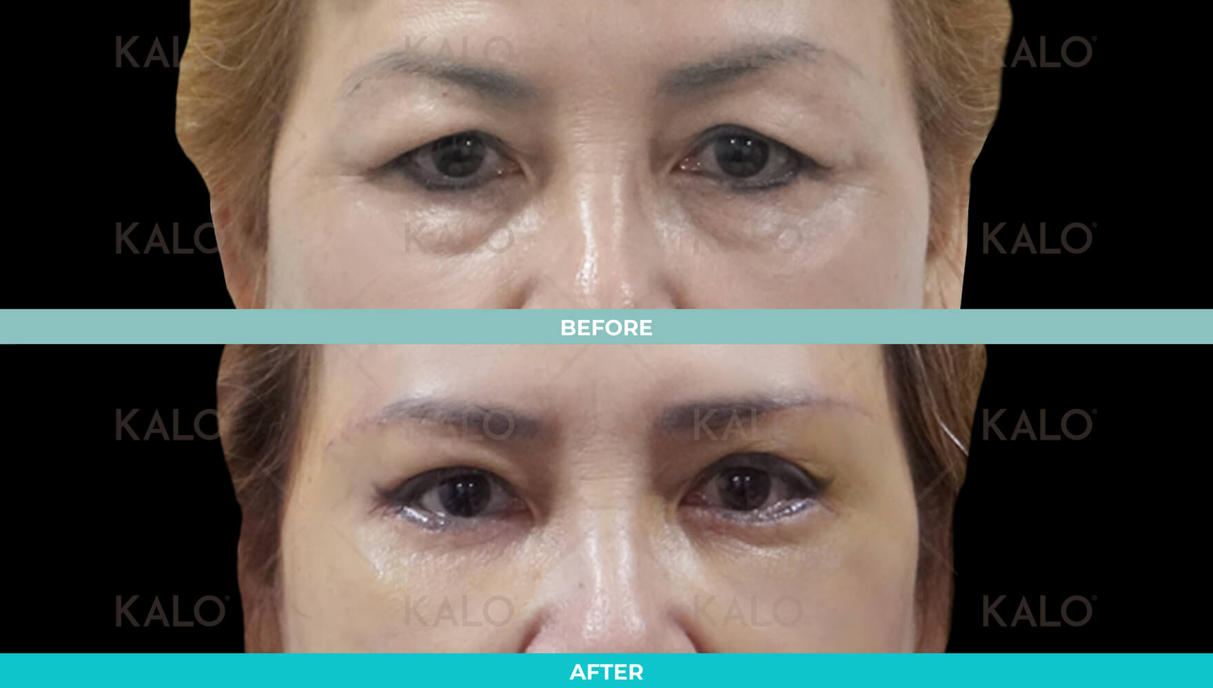 Eyebrrow Lifting 1 01