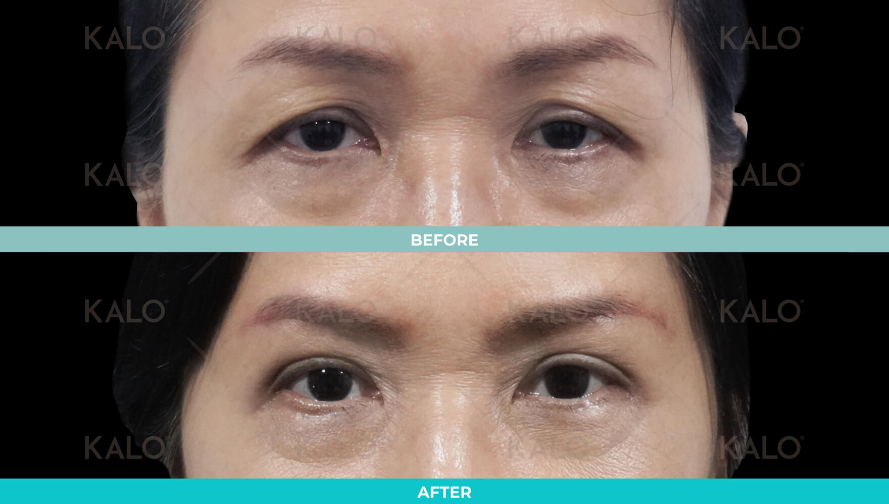 Eyebrrow Lifting 3 01