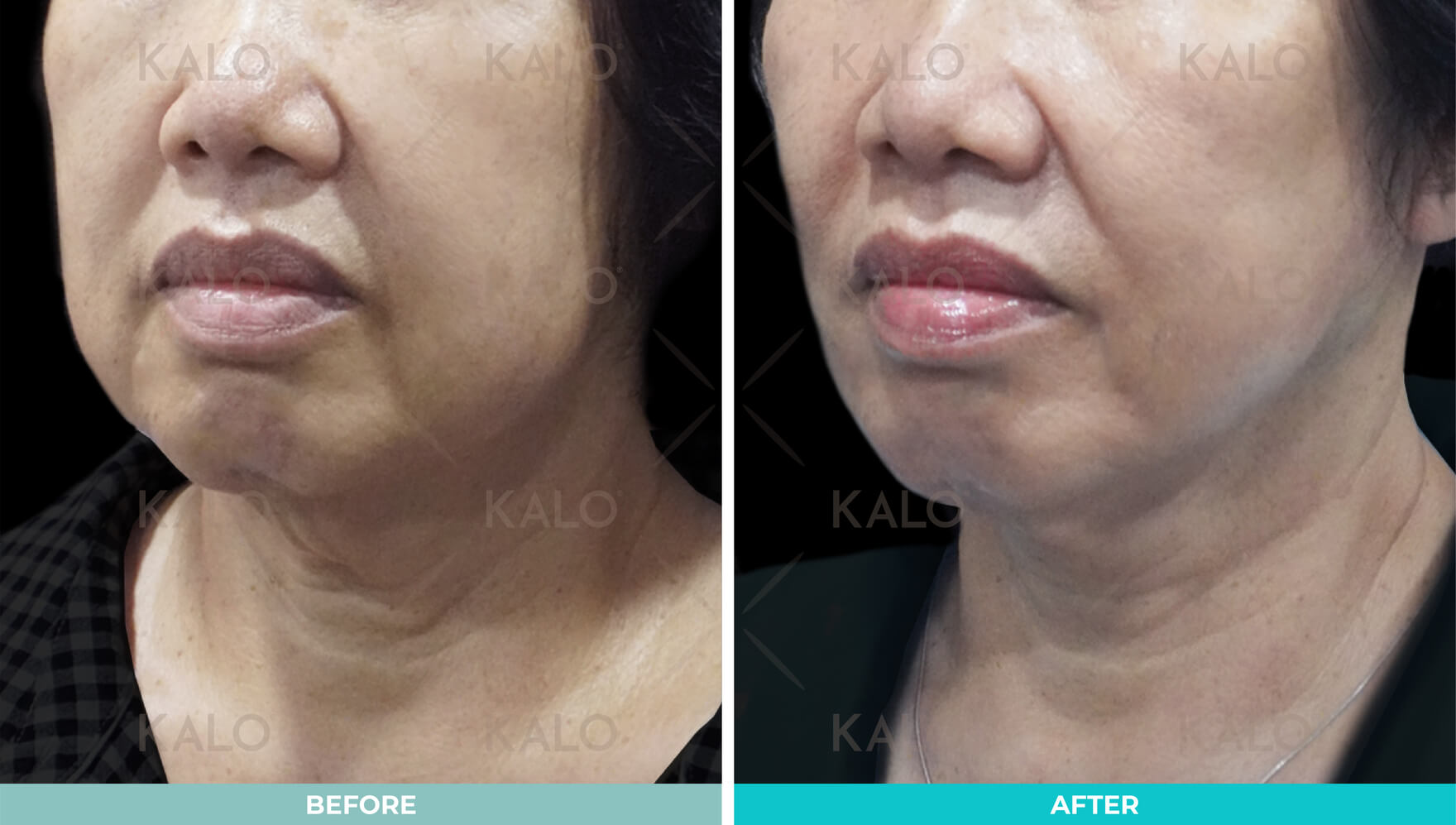 Face Lift Malaysia - Surgery 1 Facelift 1