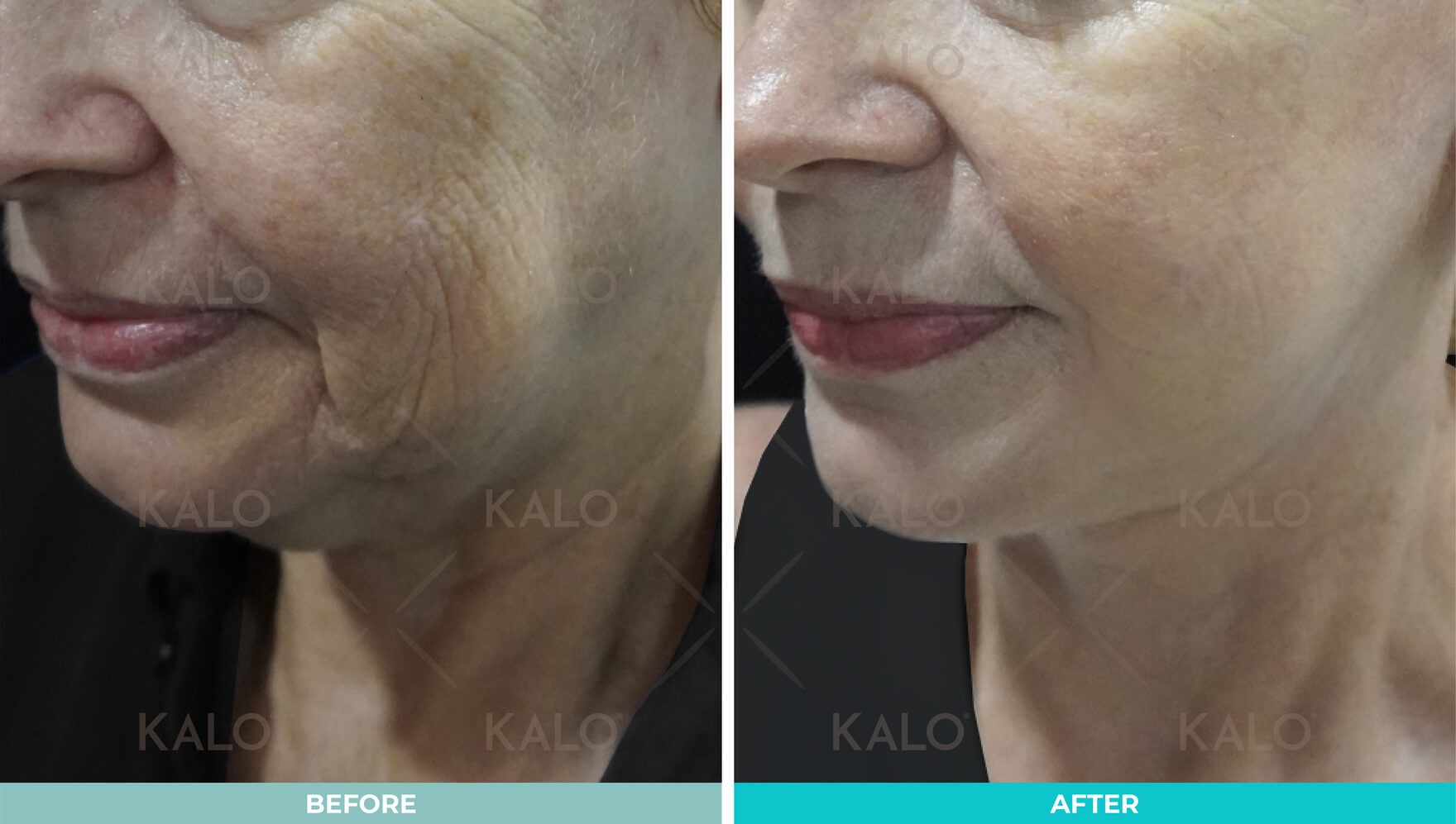 Face Lift Malaysia - Surgery 2 Facelift 2