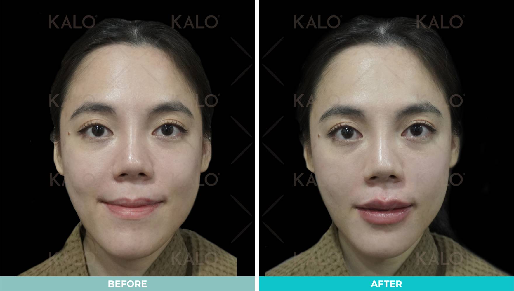 Lip Filler Injection Malaysia - Dermal Filler 1 Lip Enhancement 02