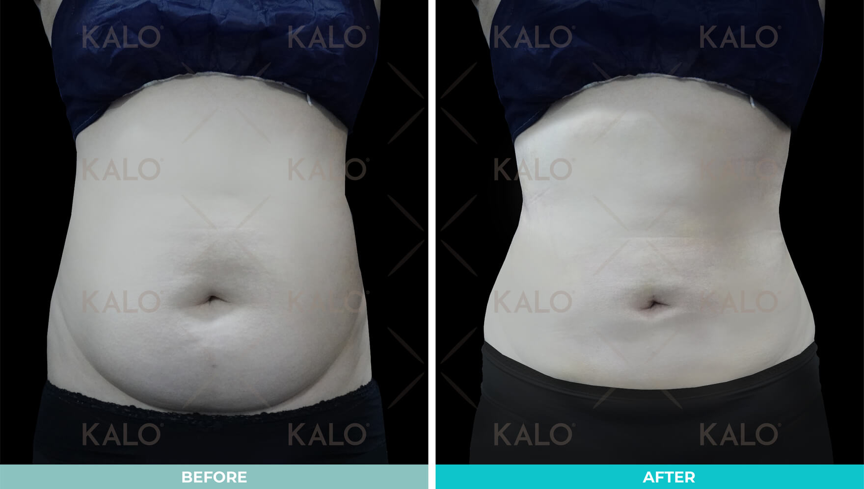 Liposuction 1