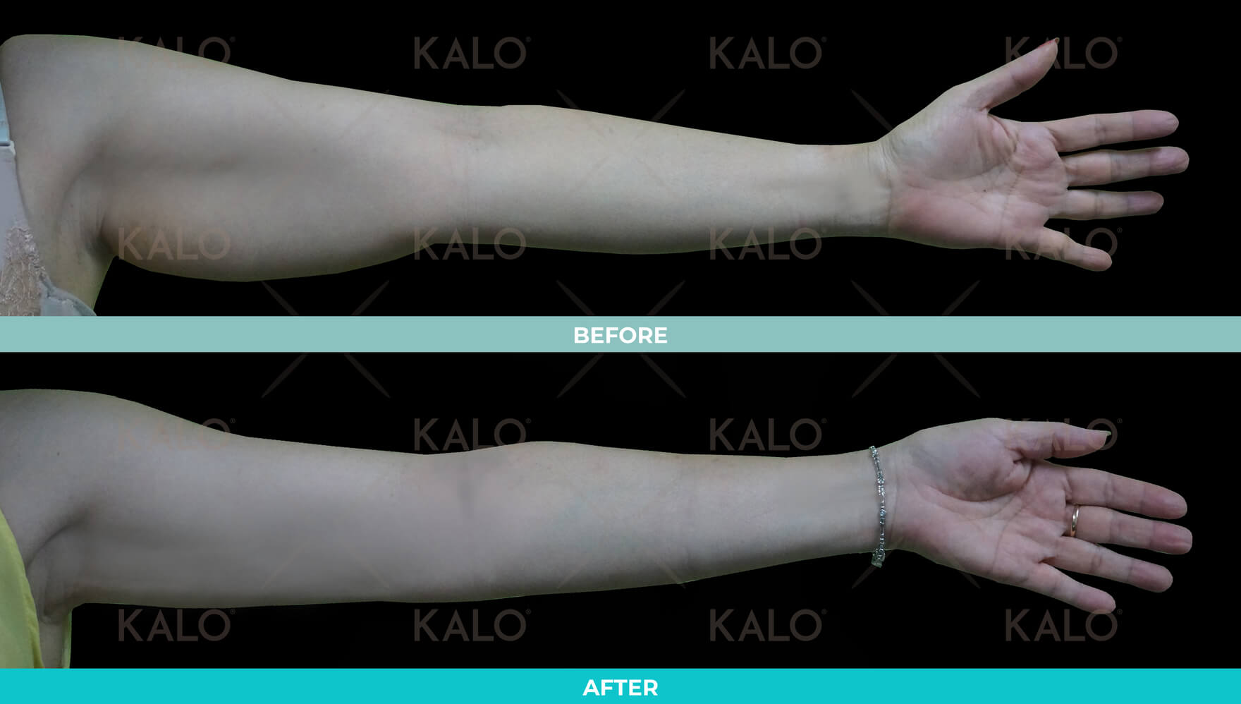 Liposuction 3