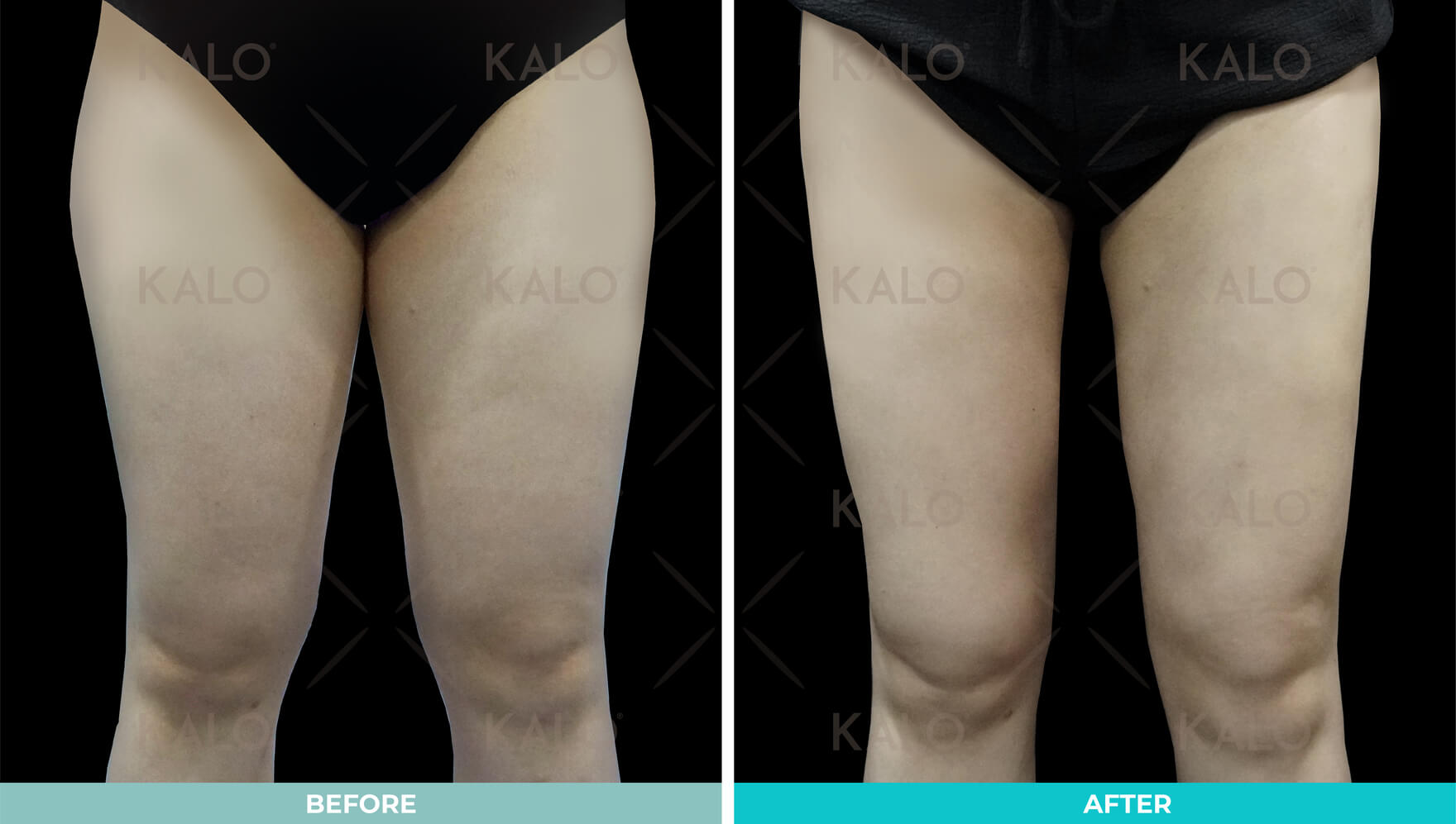 Liposuction 4