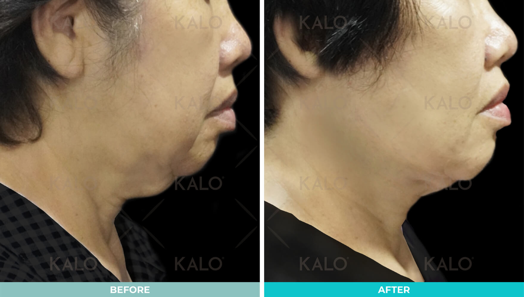 Necklift 02