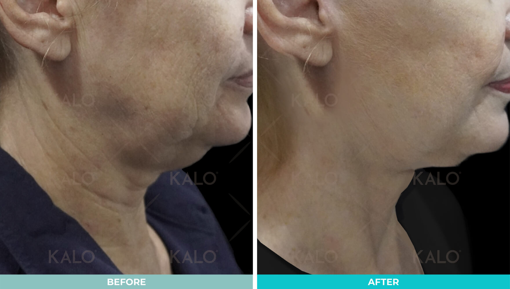Necklift 2 02