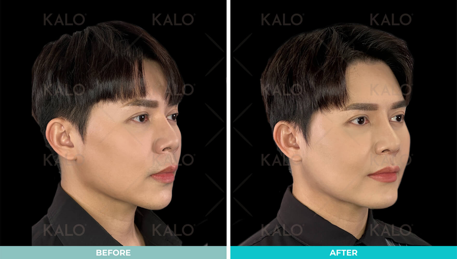 Rhinoplasty 10