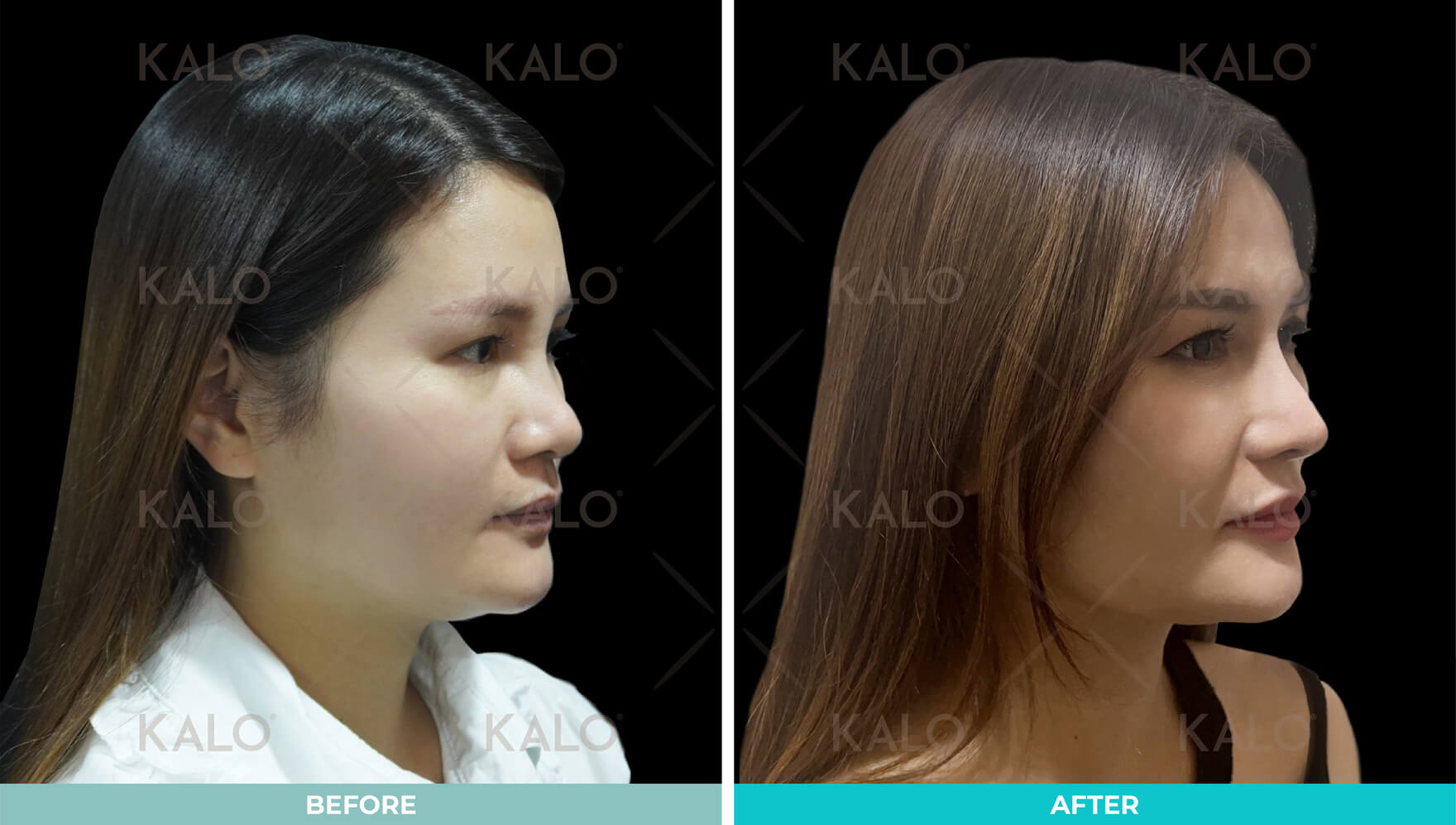 Rhinoplasty 14