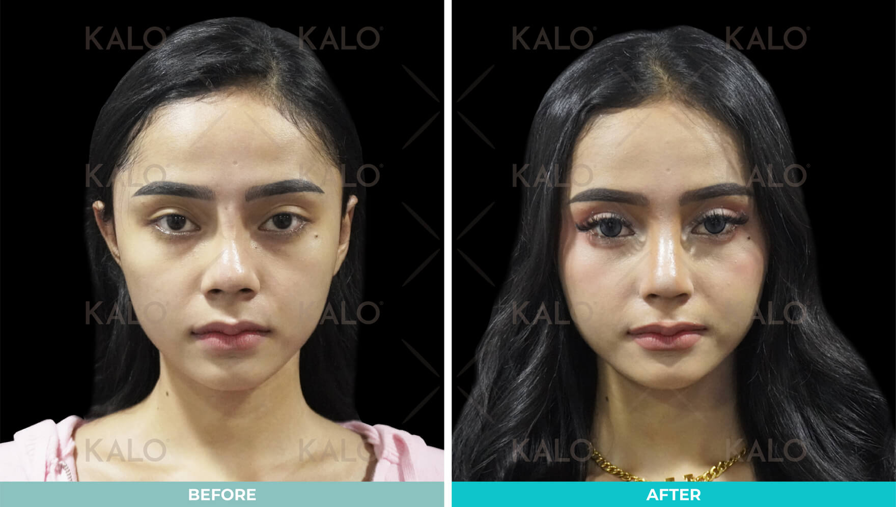 Rhinoplasty 4
