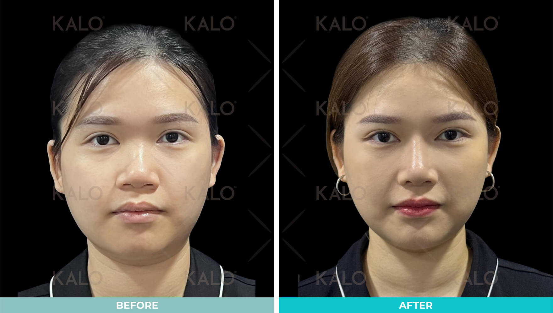 Rhinoplasty 5