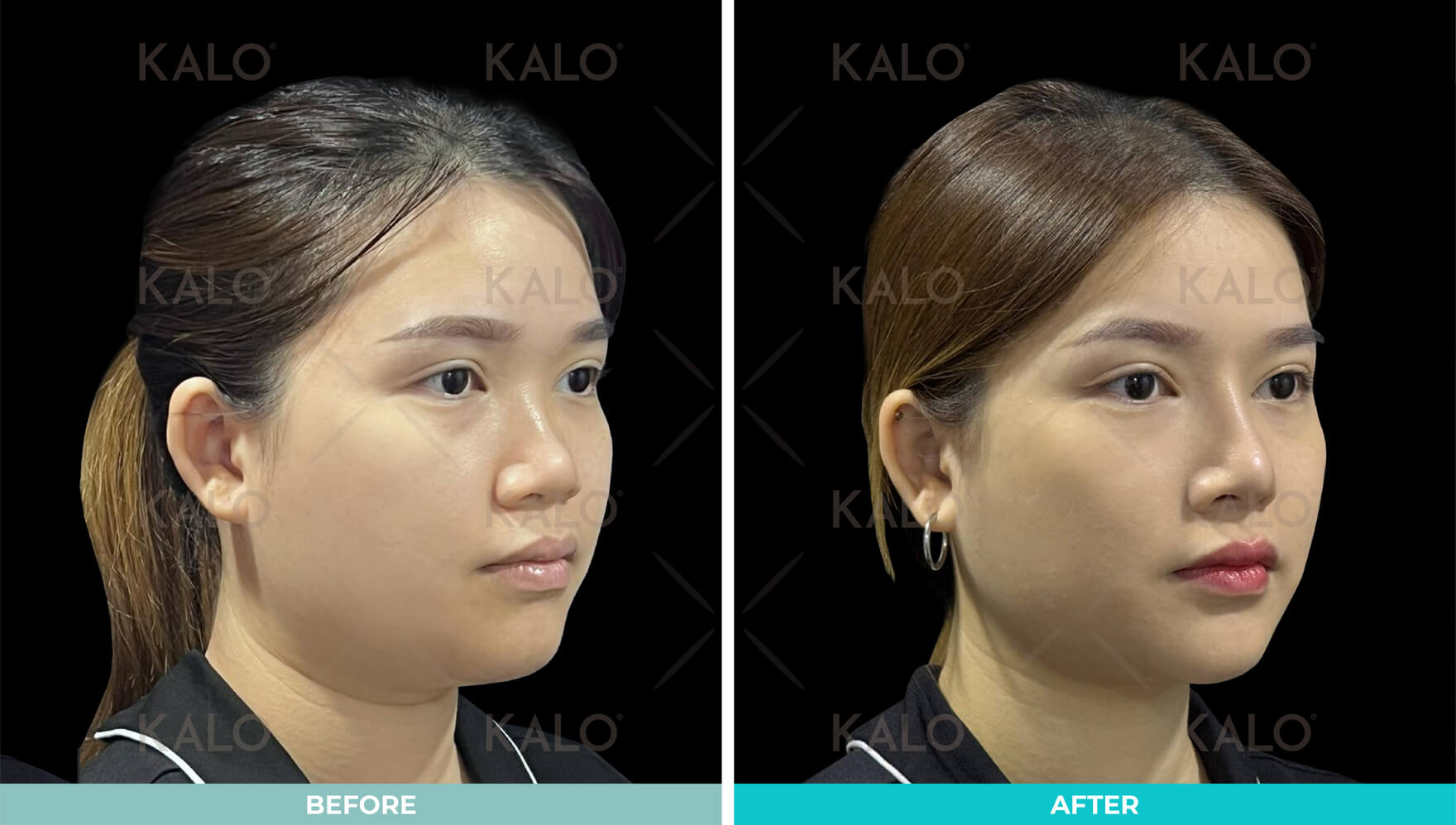 Rhinoplasty 6