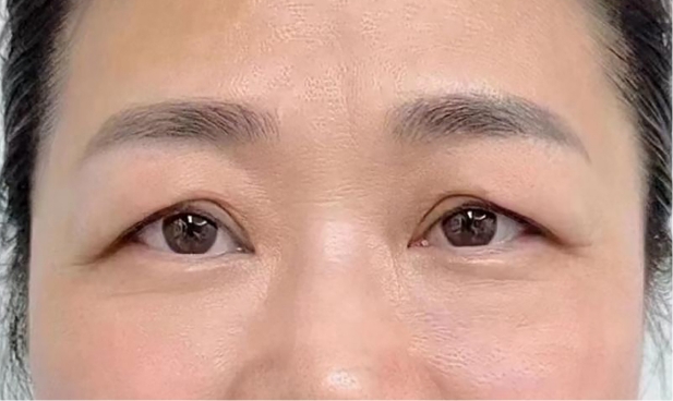 eyelid drooping 1