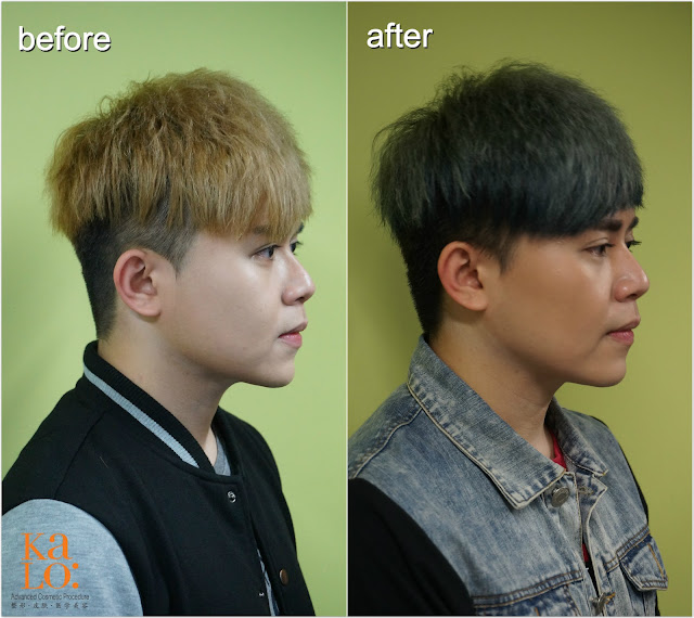 Before Face Reshape