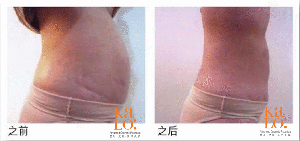 Kalo 360度定位吸脂 为你量身定制完美曲线 2 Lipo model 1