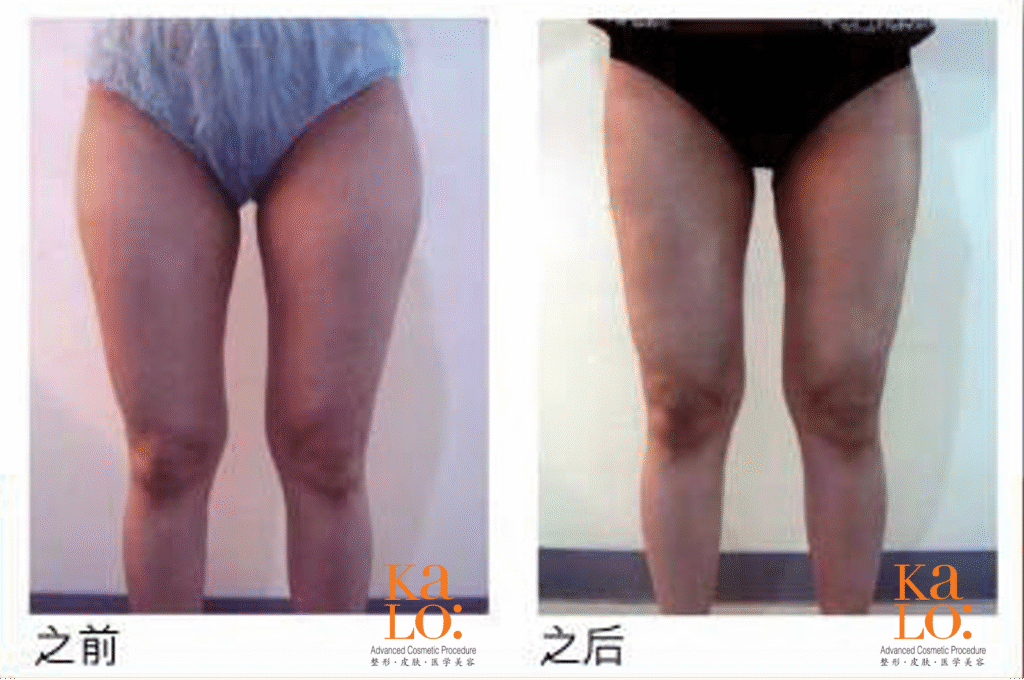 Kalo 360度定位吸脂 为你量身定制完美曲线 1 Lipo model 2