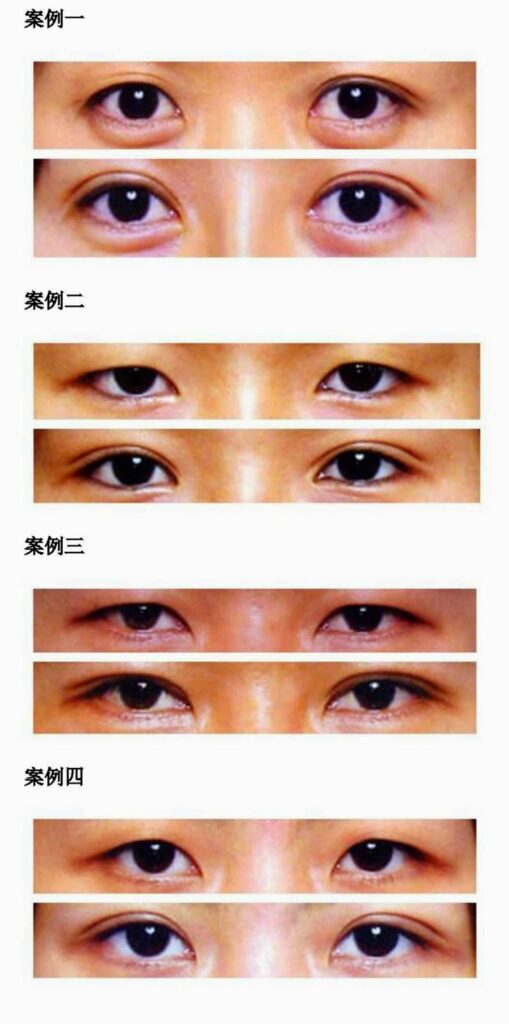 美眉们最爱的5种整形术!你知道的有哪些? 2 double eyelid