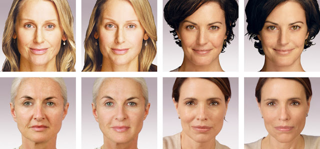 三大微整形童颜术 青春瞬间拥有! 2 juvederm before afters 1