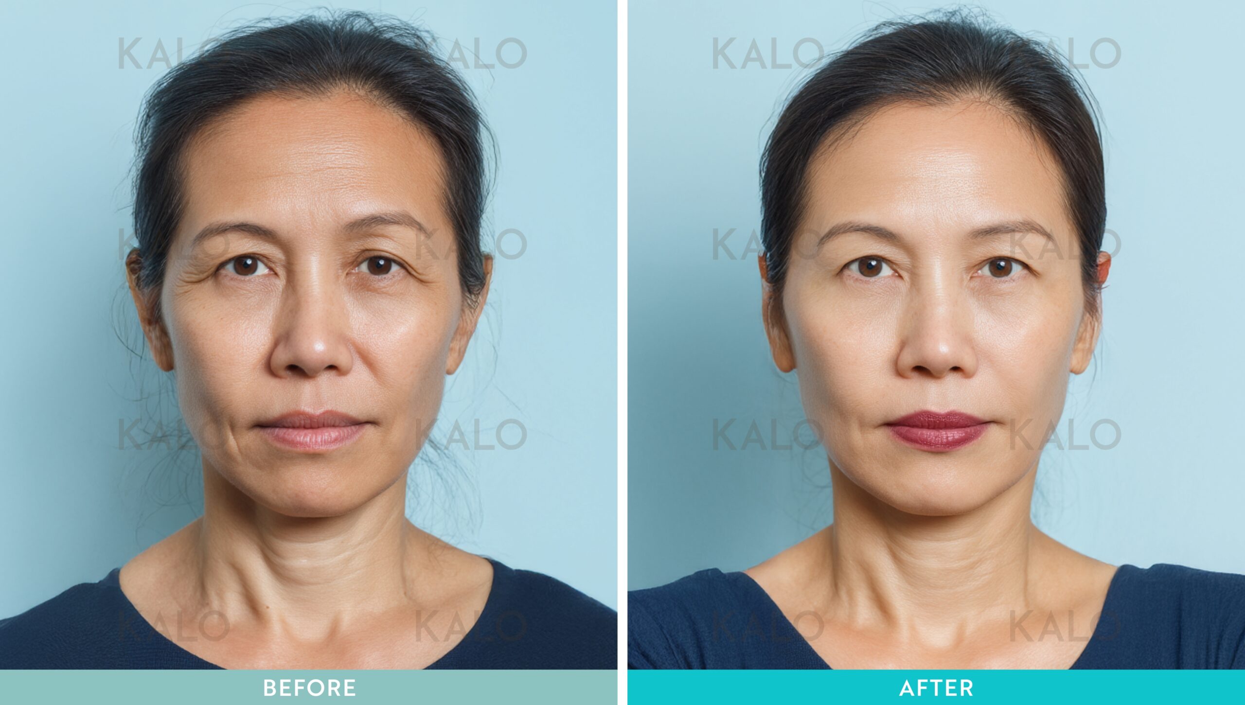 Kalo - Eyebag Removal Malaysia 41 b a 01 1 scaled