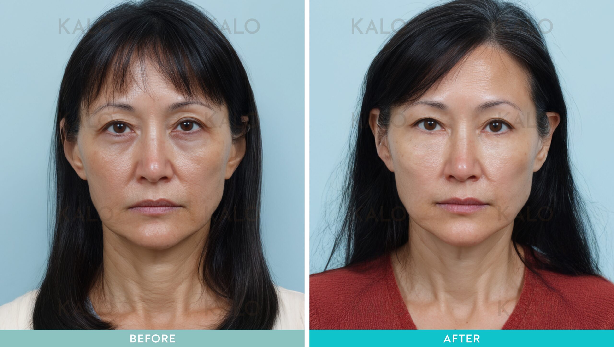 Kalo - Eyebag Removal Malaysia 42 b a 02 1 scaled
