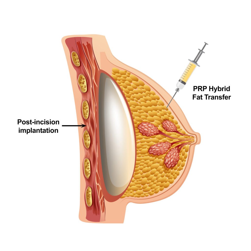 Hybrid Fat Transfer